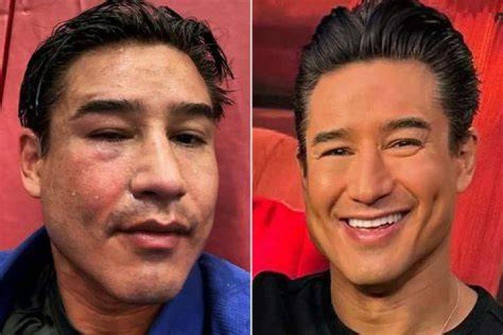 Did Mario Lopez Get A Face Lift Surgery?
